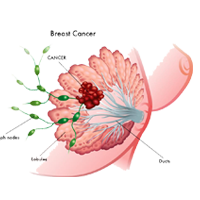 breast cancer